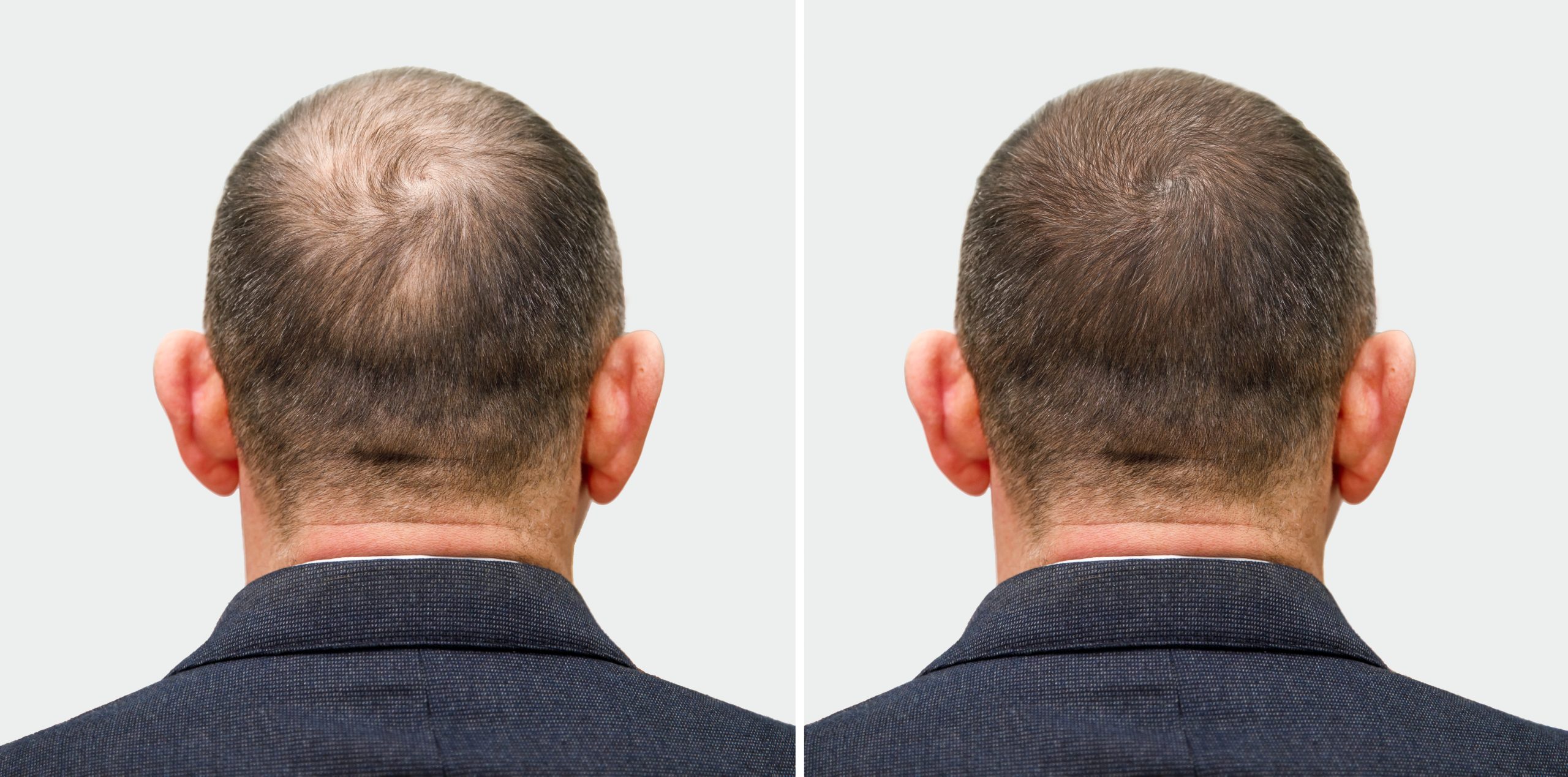 Before and after hair restoration results