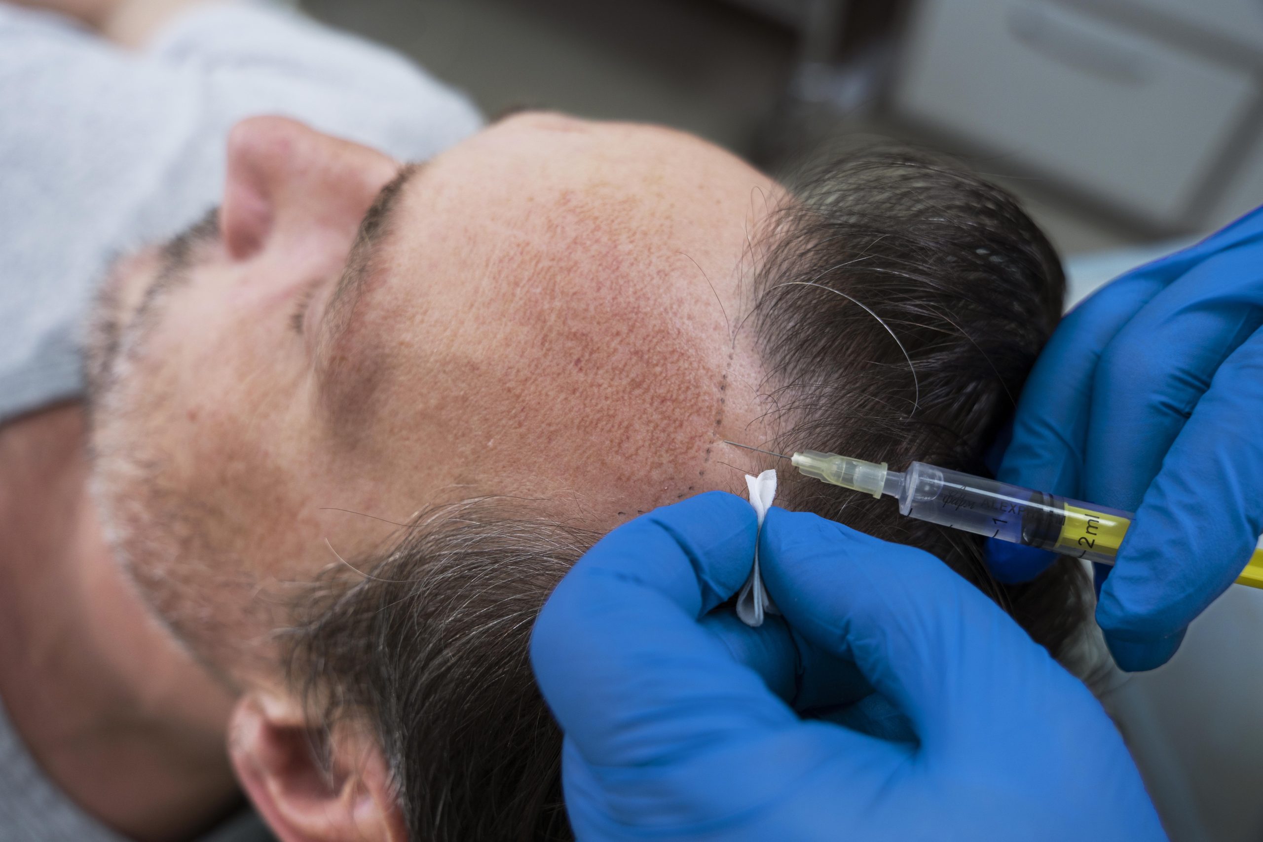 Non-surgical hair restoration treatment
