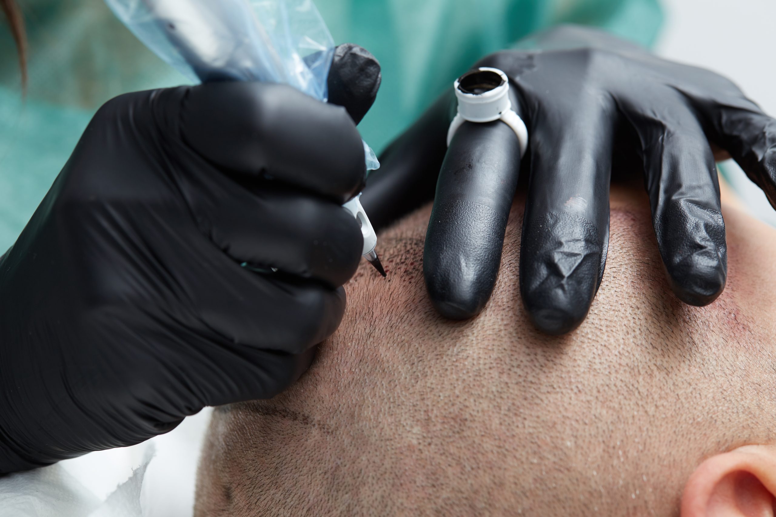Hairline and scalp restoration procedure